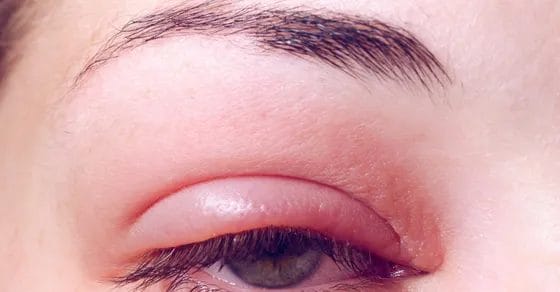 What's the Difference Between Pink Eye and a Stye?